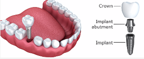 Dental Crowns